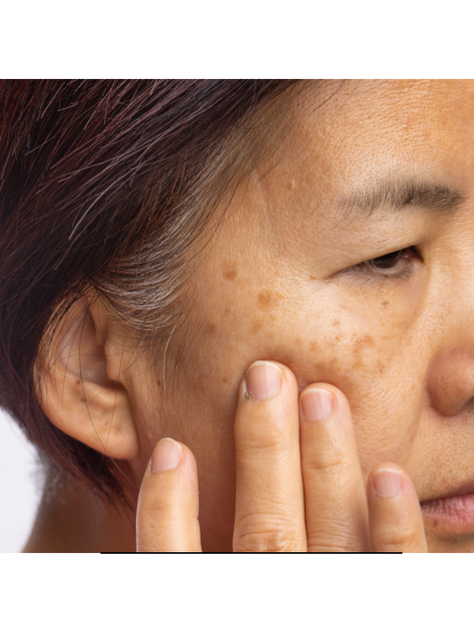 Sun, Skin, and Spots: How to Prevent and Treat Sun-Induced Pigmentation