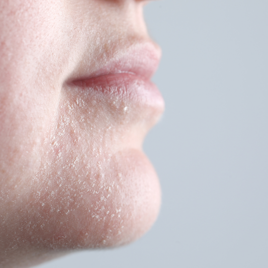 How Peri-Menopause Affects Your Skin Barrier