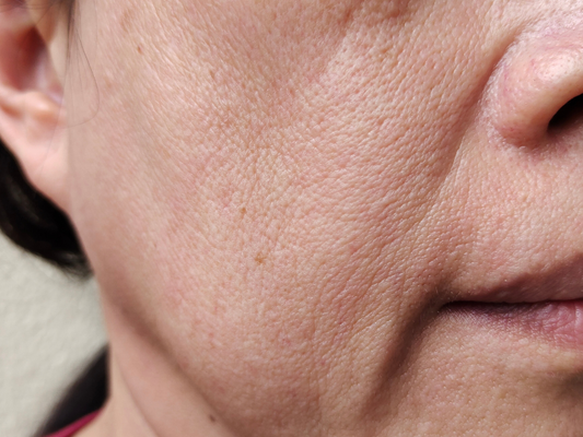 Combating Skin Laxity in the Post-Menopause Years