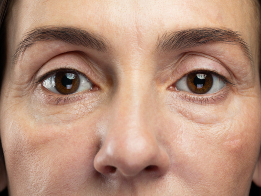 Menopause and Puffy Eyes: What’s the Link?