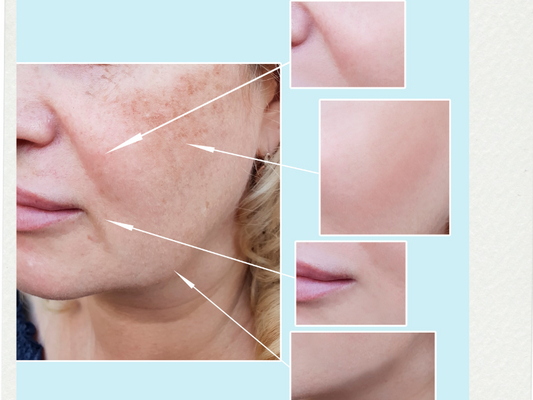 "Understanding Hyperpigmentation: Causes, Care, and Corrective Treatments"