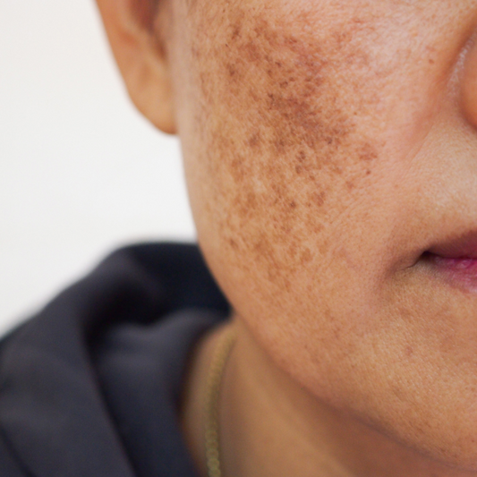 "Uneven Skin Tone? Here's What Causes Pigmentation and How to Manage It"