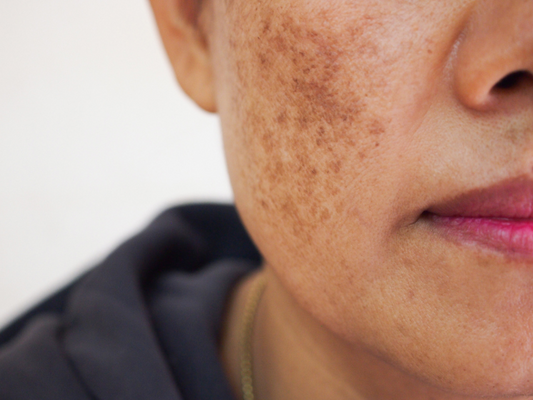 Understanding the Connection Between Menopause and Hyperpigmentation