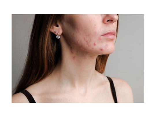 What Peri-Menopause Acne Looks Like and How to Treat It