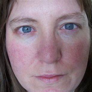 Managing Red, Flushed Skin During Menopause
