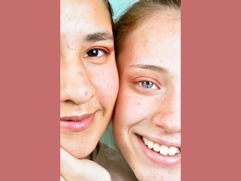 "From Breakouts to Clear Skin: What Actually Works for Acne"