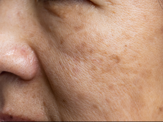 Post-Menopause and Sun Damage: Prevention and Care
