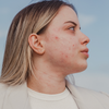 Peri-Menopause and Acne: What’s Causing These Breakouts?