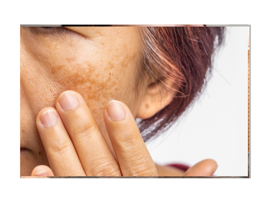 Understanding Peri-Menopause: Skin Changes and Environmental Sensitivities