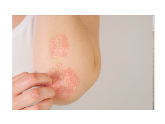 Peri-Menopause and Eczema: What You Need to Know
