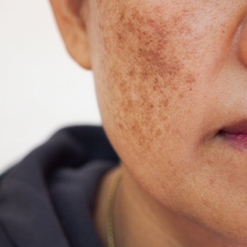 "Uneven Skin Tone? Here's What Causes Pigmentation and How to Manage It"